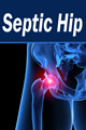Septic Hip Calculator